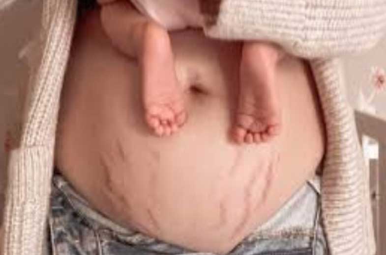 برای جلوگیری از ترک پوستی در بارداری چه کنیم؟